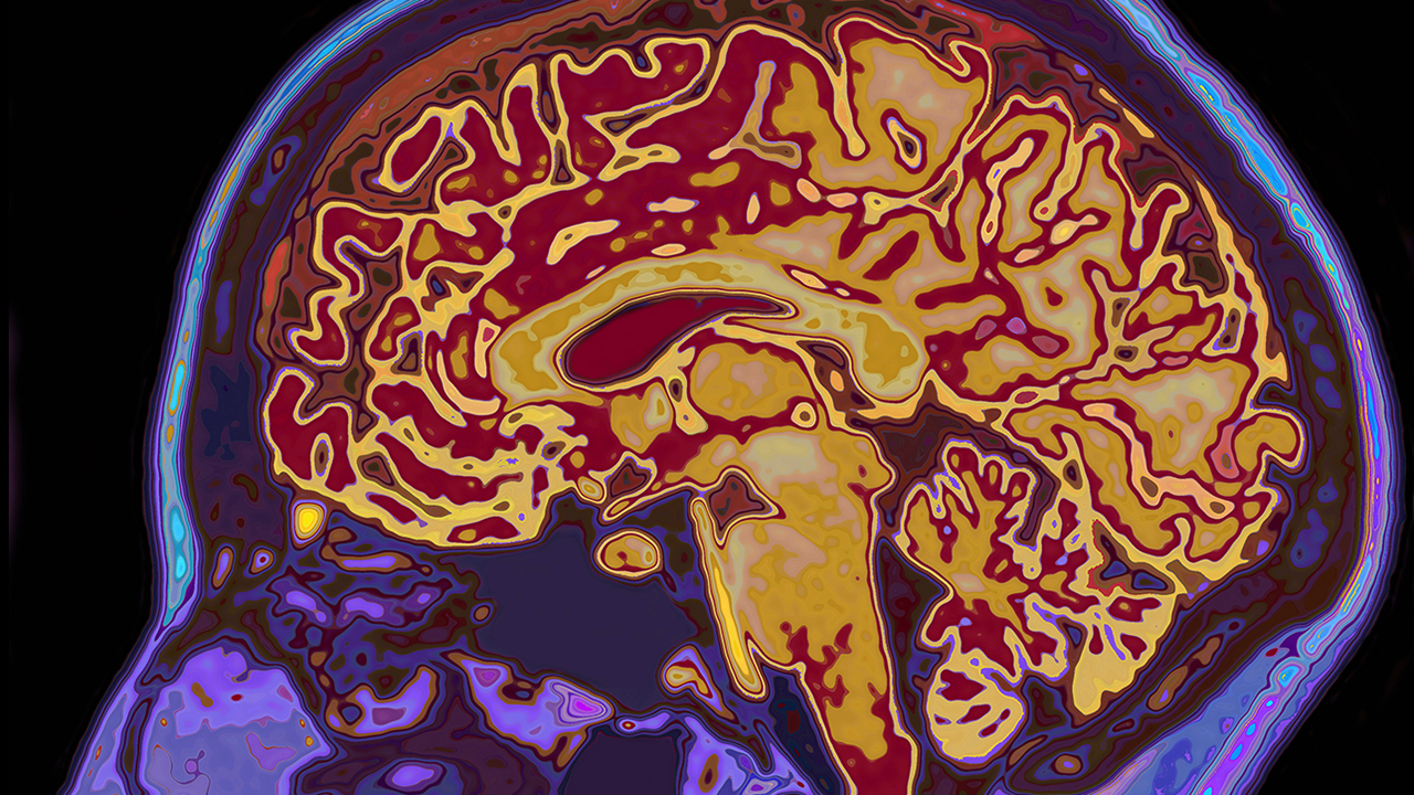 MRI brain scan image