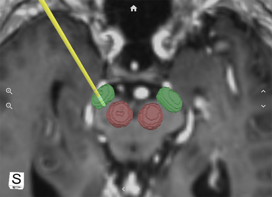 A 3D model with specific brain regions highlighted and a surgical node implanted
