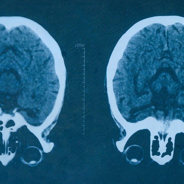 Two medical scans of a brain